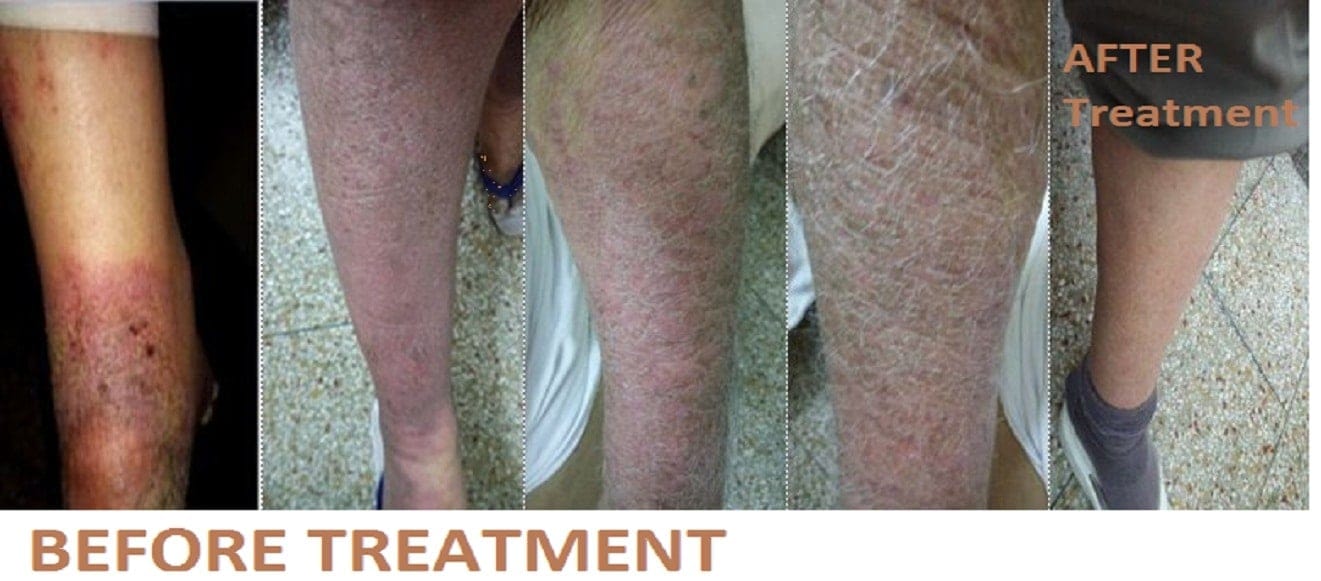 DESQUAMATION OF SKIN